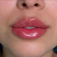 تزریق ژل (فیلر) و بوتاکس|خدمات آرایشگری و زیبایی|شیراز, عادل آباد|دیوار