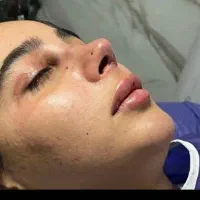 آف عمل بینی فقط ۲۲ انجام میشه