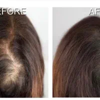 میکرواسکالپ سر|خدمات آرایشگری و زیبایی|جهرم, |دیوار