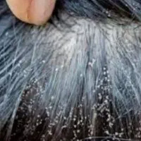 مایع رفع شپش مو