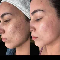 فیشال و مزونیدلینگ پوست و لیفت مژه ابرو و کاشت مژه|خدمات آرایشگری و زیبایی|تهران, تهرانپارس غربی|دیوار