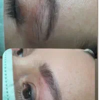 الکترولیز تنها روش قطعی از بین بردن هر نوع مو