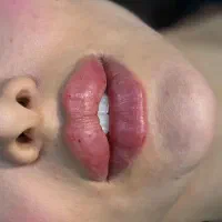 تخفیفات پاییزی  ژل ،بوتاکس،فیلر،مزو،آنزیم  پرسینگ