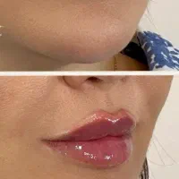 جشنواره بوتاکس مصپورت ۶۵۰فیلر ۶۹۰ فقط تا آخر آبان|خدمات آرایشگری و زیبایی|اصفهان, شمس آباد|دیوار