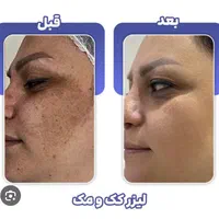 حذف انواع ککومک لک ملاسما و تیرگی در یک جلسه|خدمات آرایشگری و زیبایی|همدان, |دیوار