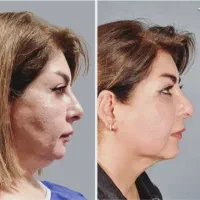 جراحی بلفاروپلاستی وجراحی های زیبایی و تزریقات|خدمات آرایشگری و زیبایی|قائمشهر, |دیوار