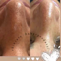 تخفیف فیشیال کلاسیک(رفع جوش سرسیاه)|خدمات آرایشگری و زیبایی|دوگنبدان, |دیوار