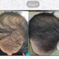 کیت رویش مجدد مو، کاهش ریزش، بدون ماینوکسیدیل