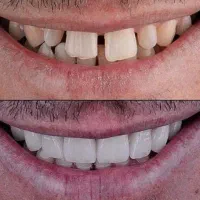 (ارتودنسی) به صورت تمام اقساط