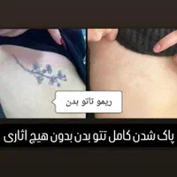 حذف تتو پاک کردن تتو بالیزر/رفع تیرگی/رفع کک و مک|خدمات آرایشگری و زیبایی|مشهد, هنرستان|دیوار