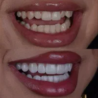 ارائه خدمات کامپوزیت ولمینیت دندان (ونیرکامپوزیت )|خدمات آرایشگری و زیبایی|کرج, مهرویلا جنوبی|دیوار
