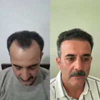 جشنواره کاشت مو ریش و ابرو|خدمات آرایشگری و زیبایی|مراغه, |دیوار