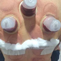 حجامت بادکش آتشی رفع گرفتگی درد عضلات زالو منظریه