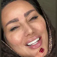 کامپوزیت دندان با کمترین پیش پرداخت/اقساطی