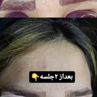 پاک کردن تاتو با دستگاه لیزر پیشرفته|خدمات آرایشگری و زیبایی|ماهدشت, |دیوار