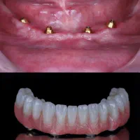 دندانپزشکی اوردنچر دوفک ۲۰۰ تومن با ۸ پایه
