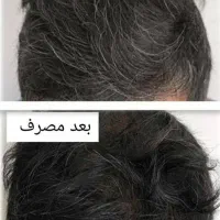 درمان ریزش مو قطعی|فعالیت داوطلبانه|قیدار, |دیوار