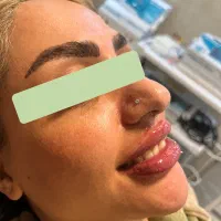 فیلرلب/ژل لب/توسط پزشک/انواع مدل ژل لب|خدمات زیبایی و سلامت|مشهد, عامل|دیوار