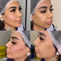 تزریق فیلر خط لبخند،چانه،گونه و زاویه فک توسط پزشک