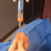 تزریق فیلر بادی ،ساکشن، تزریق چربی صورت و بدن|خدمات آرایشگری و زیبایی|صدرا-فارس, |دیوار