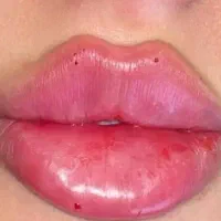 تزریق ژل و بوتاکس|خدمات آرایشگری و زیبایی|اردبیل, |دیوار