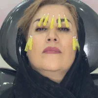 لیفت با نخ و جوانسازی با نخ با قیمت عالی توسط پزشک