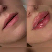 اموزش تخصصی وخدمات ژل بوتاکس چالگونه پرسینگ تتو