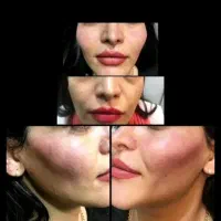 ژل ، بوتاکس ، چربی ، فیلر|خدمات آرایشگری و زیبایی|کرمانشاه, |دیوار