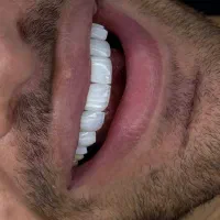 کامپوزیت لبه شیشه ای فقط فکی ۲۰ تومن
