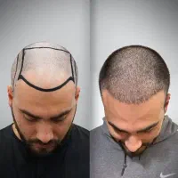 مرکز تخصصی کاشت مو تکنولوژی روز و نتایج استثنائی