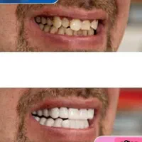 لمینت  دندان متحرک ۴۸۰