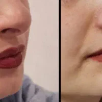 مدل جهت ژل وبوتاکس وانزیم|خدمات آرایشگری و زیبایی|نهاوند, |دیوار