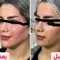 تزریق ژل و بوتاکس|خدمات آرایشگری و زیبایی|اهواز, نادری|دیوار