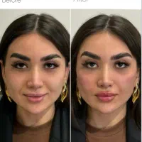 فیلر بوتاکس