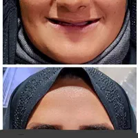 دندان دندانسازی پروتز با چک