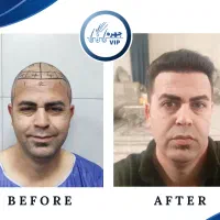 کاشت مو پرتراکم|خدمات آرایشگری و زیبایی|تهران, ونک|دیوار