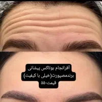 تزریق ژل و بوتاکس