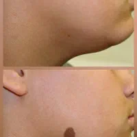 برداشتن خال،زیگیل،کک و مک، ماه‌گرفتگی