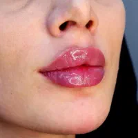 جشنواره ژل بوتاکس فیلرمزو لیزرتضمینی مطب زیبایی