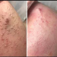 پاکسازی و فیشیال پوست|خدمات آرایشگری و زیبایی|باقرشهر, |دیوار