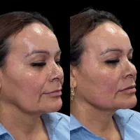 مطب پزشک/فیلر/مزو/پی آر پی/prp