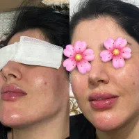 ژل بوتاکس پیرسینگ مزوژل آنزیم آموزش|خدمات آرایشگری و زیبایی|اسلام‌‌آباد غرب, |دیوار