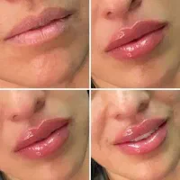 ژل و بوتاکس|خدمات آرایشگری و زیبایی|بجنورد, |دیوار