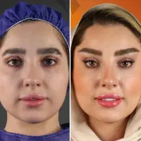 بلفاروپلاستی لیفت صورت بوکال فت تزریق چربی|خدمات آرایشگری و زیبایی|کرمانشاه, |دیوار