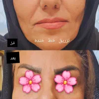 چهره‌ای که عاشقش میشی،بوتاکس،ژل وفیلر توسط متخصص|خدمات آرایشگری و زیبایی|ارومیه, |دیوار