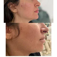 تزریق ژل سی سی 600|خدمات آرایشگری و زیبایی|پیشوا, |دیوار