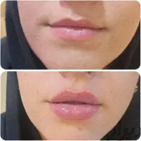 جشنواره ژل و بوتاکس و مزوتراپی لک وجوانسازی بانوان|خدمات آرایشگری و زیبایی|اصفهان, عسگریه|دیوار