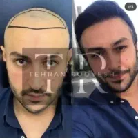 جشنواره کاشت مو یک روزه فول تراکم|خدمات آرایشگری و زیبایی|تهران, دزاشیب|دیوار