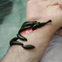 طب سنتی سیاتیک کمر درد دیسک بادکش حجامت زالو فصد|خدمات آرایشگری و زیبایی|ملارد, |دیوار