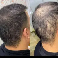 جلوگیری ازریزش مو ورویش مو آلوپسی سکه ای